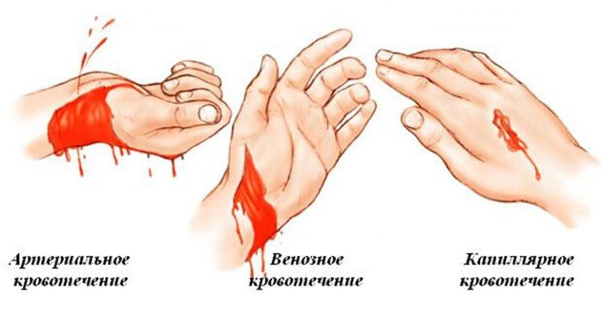 типы кровотечений